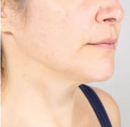 ultherapy before after